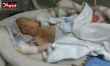 حديثو الولادة عرضة للموت في ظل حصار جنوب دمشق